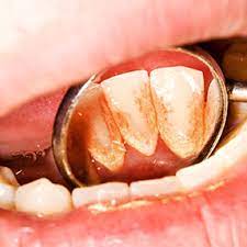 U&G"®" Organic Tooth Powder (Pain Relife In Just 5 Min)